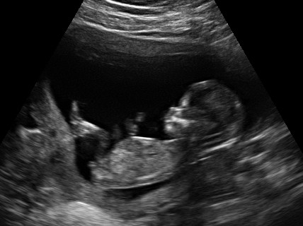 Baby Ultrasound Pictures on Weeks 2 Days Pregnant  When I Look At The Small Image Of The Baby